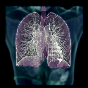 肺结节CT Chest 或 Lung 3D 在模糊的人体背景上拍摄图象 用于诊断肺结核 结核病和共生19背景