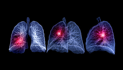 肺结节CT 肺3d 肝脏成象药品诊断屏幕辐射器官病人肺炎断层监控呼吸系统背景