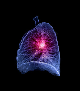 肺病学隔膜肺结节高清图片