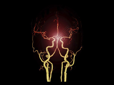 CT图CTA BRIAIN 或CT脑3D成像图显示脑动脉头痛3d系统辐射颅骨检查技术背景扫描仪血液循环背景