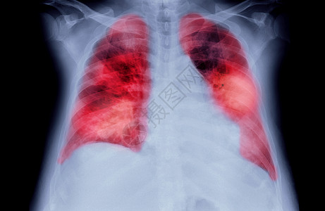 人类胸前或肺部(红区)显示肺结核的X光切片或X光图像图片
