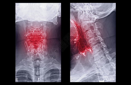 消化道癌Esophagram或Biamor 燕子AP和横向视图显示食道 用于诊断GERD或气旋性回流疾病和眼癌背景