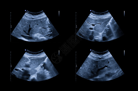 小腹疼超声波上腹部显示肝脏和胆囊 用于筛查肝细胞癌和凝石诊断解剖学病人积液回声扫描检查脓肿胰腺卵巢背景