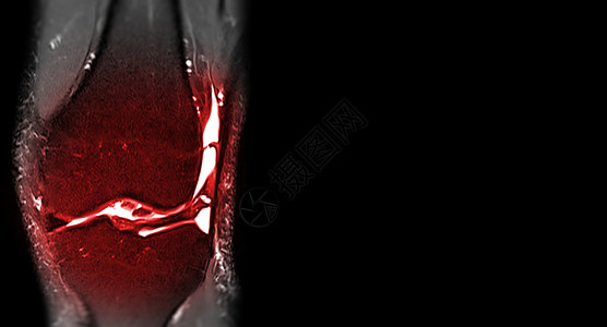 MRI 膝下冠日冕视图卫生末端医院扫描器创伤磁铁诊断放射科肌腱疼痛检查高清图片素材