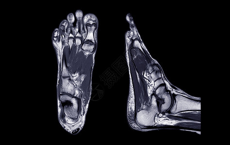 脚部或轴 科罗纳尔和人形外观的动脉共振成像 用于诊断趋势损伤腓骨骨骼解剖学电影治疗医师医院放射科骨科电脑背景