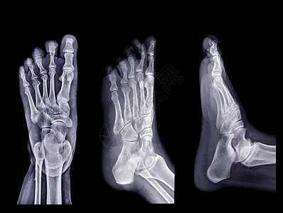 Foot X射线图像集 在黑色背景中分离高清图片