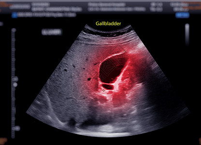 超声波上腹部显示胆囊 用于诊断胆囊石膀胱感染小腹回声肝炎疾病扫描卵巢怀孕异质背景图片
