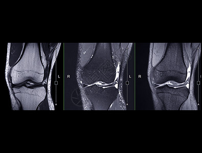 磁共振成像或 MRI 膝盖比较骨高清图片素材
