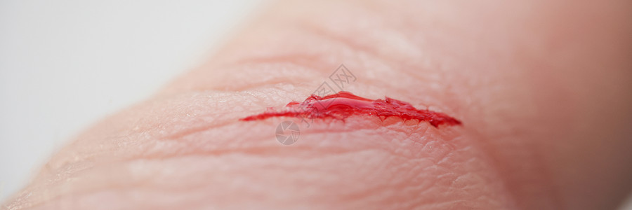 伤者手指指有流血的露口伤口皮肤感染创伤安全男人微生物宏观流动裂伤痛苦图片