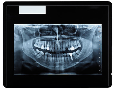 牙齿建模图牙齿成像射电图射线医学药店骨骼治愈科学下颌医院x射线牙科背景