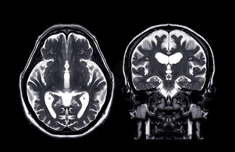 MRI 脑核磁共振二氧化T2和日冕t2f技术背景