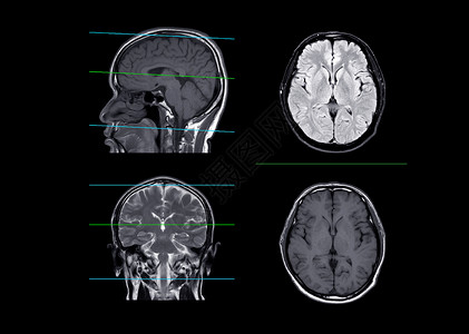 冠头岭MRI 脑部对比轴 日冕和人造平面背景