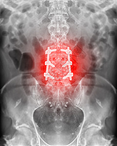 人造骨骼隆巴脊椎的X光图像 与冰球螺丝固定外科神经金属板腰背脊柱柱子替代品治疗科学疾病背景