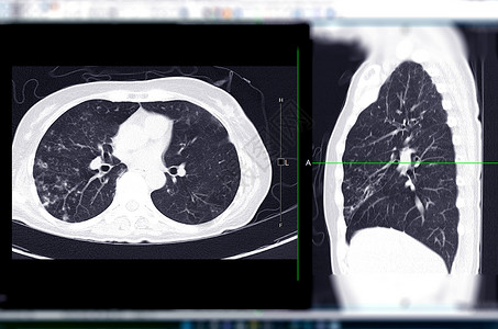 肺ctCT 肺轴和验尸视图的切片或切片扫描解剖学主动脉检查注射医院肺部流感癌症传染病呼吸系统背景