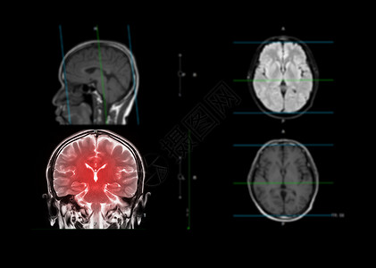 核磁共振大脑显示大脑的日冕平面背景