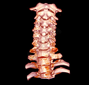 腺样体CT 子宫颈脊椎3D剖析 SCAN颈椎病疾病创伤骨骼疝气颈椎诊断脊柱痛苦螺丝背景