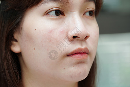 皮肤脸部的骨灰和伤疤 塞巴塞氏腺紊乱 少女皮肤护理美容问题药品皮脂腺青春期治疗缺陷瘢痕皮肤科前额感染卫生背景图片