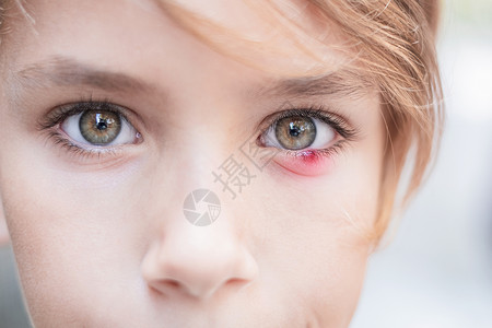 溶血性链球菌近距离接近儿童眼部 脑膜炎症脓肿皮肤大麦疾病女性症状链球菌药品眼泪女孩背景
