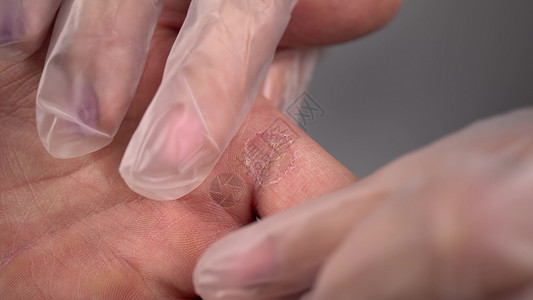 皮肤真菌医生检查一个男人手上的骨 苍蝇皮肤病 亲近手背景