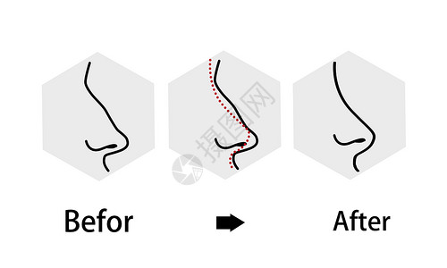 韩式整形技术鼻子整形修复过程插画