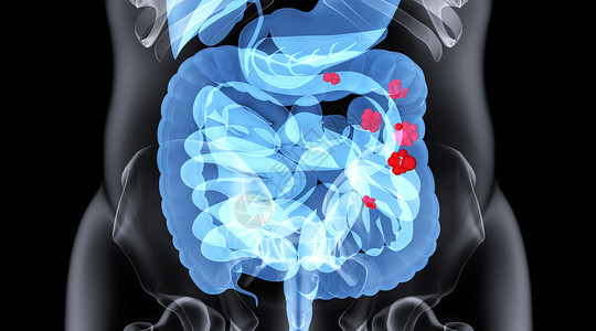 肿瘤类肠道疾病场景设计图片