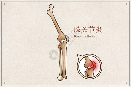 膝盖疼痛膝关节炎示意图插画