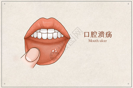 嘴干口腔溃疡医疗插画示意图插画