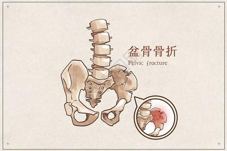 盆骨骨折示意图生病高清图片素材