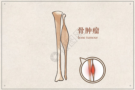 骨肿瘤示意图临床高清图片素材