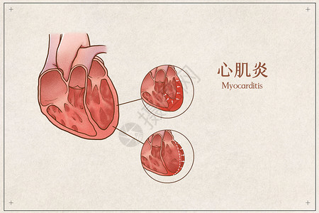 心肌炎医疗插画示意图高清图片