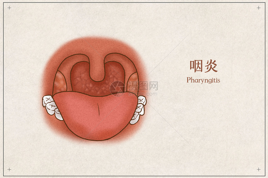 咽炎医疗插画示意图图片