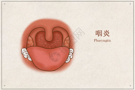 咽炎医疗插画示意图背景图片