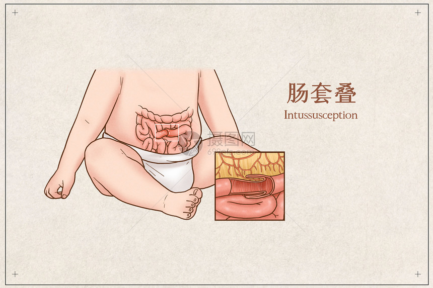 肠套叠医疗插画图片