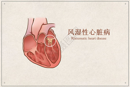 风湿性心脏病医疗插画图片素材