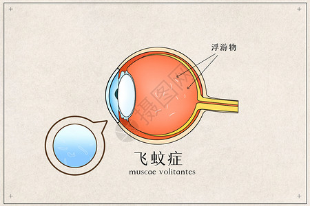 眼球飞蚊症医疗插画插画