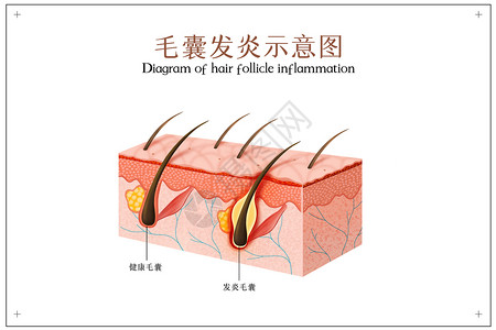 面部毛发毛囊发炎示意图插画