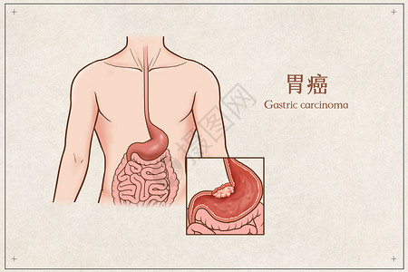 肚子叫胃癌医疗插画插画