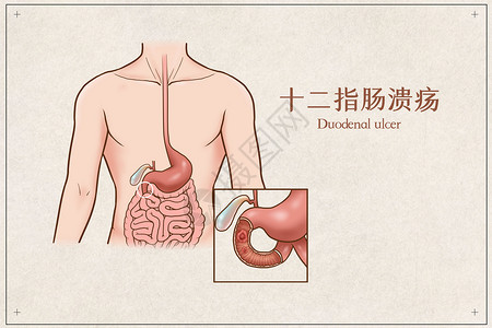 十二指肠溃疡医疗插画高清图片