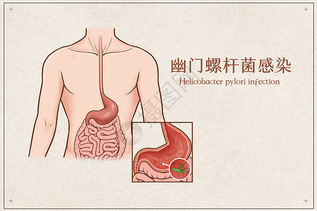胃管幽门螺杆菌感染医疗插画插画
