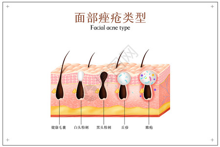 面部痤疮类型图片