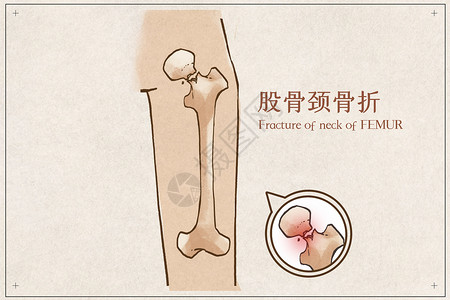 股骨颈骨折病例医疗插画高清图片