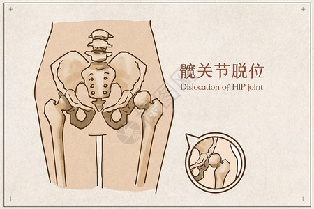 股骨髋关节脱位病例医疗插画插画