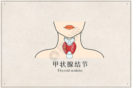 甲状腺结节医疗插画背景图片