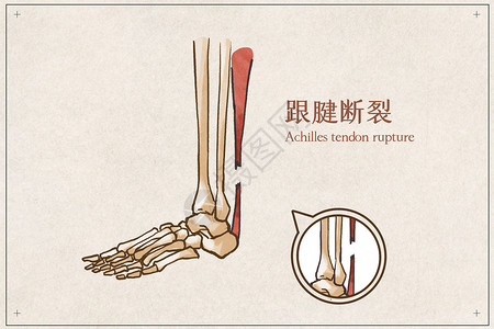 肌肉解剖图跟腱断裂病例医疗插画插画