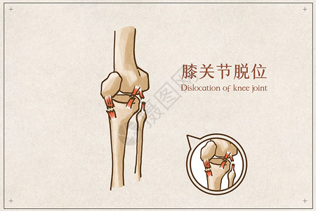 膝关节脱位骨连接骨外科高清图片