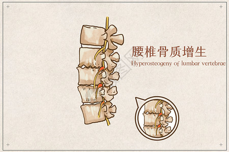 腰椎固定器腰椎骨质增生插画