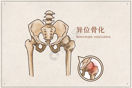 异位妊娠异位骨化插画