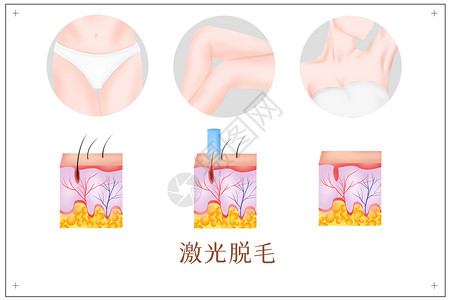 激光美容激光脱毛医美插画插画