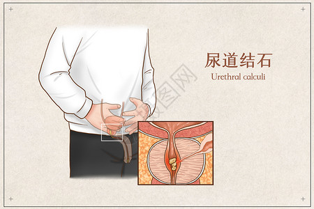 尿道结石医疗插画高清图片