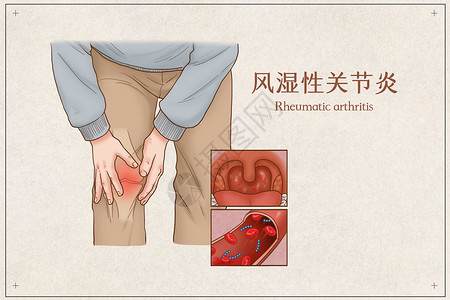 联合出品风湿性关节炎医疗插画插画